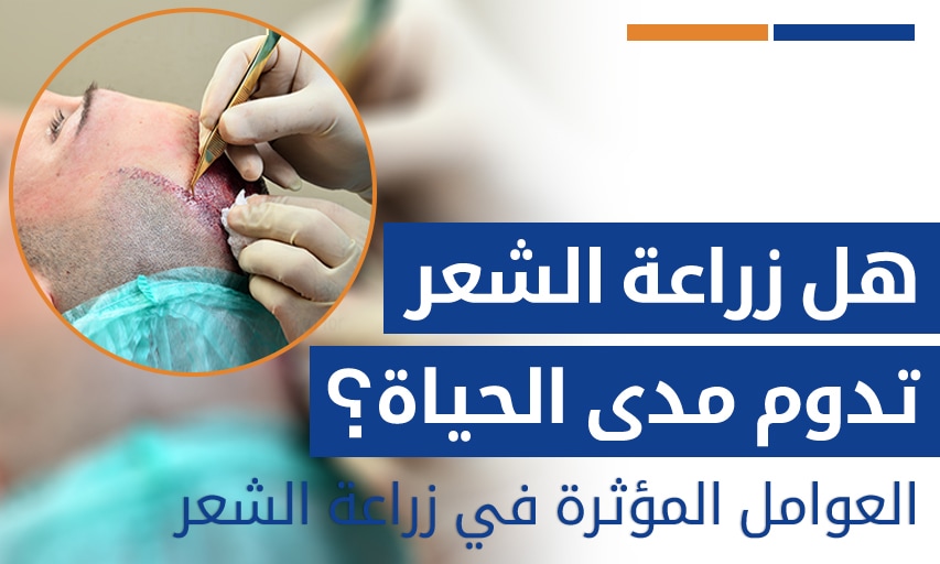 هل زراعة الشعر تدوم مدى الحياة؟ العوامل المؤثرة في زراعة الشعر